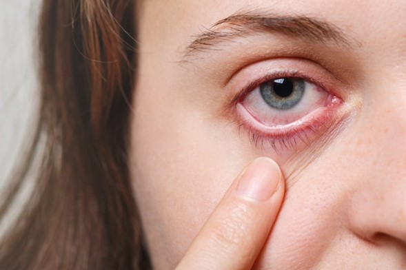Uveitis: Navigating the Eye’s Silent Storm