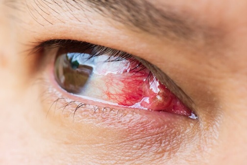 The Sun’s Silent Signal: Unveiling Pterygium